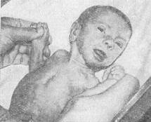 Рис. 2. Рефлекс Бабкина